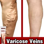 crema-para-varices-efectiva