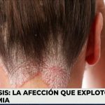 factores-que-empeoran-la-psoriasis